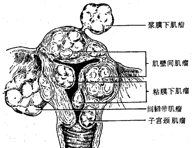 子宫肌层病变的超声诊断