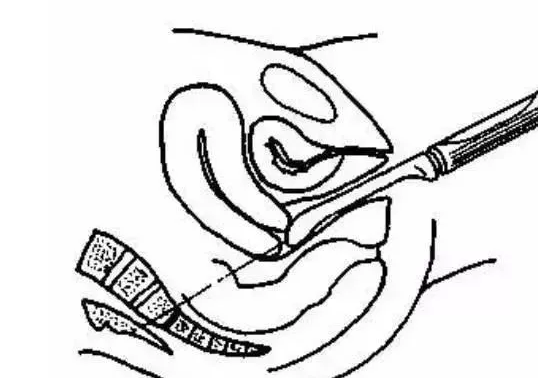 阴道超声检查的优点